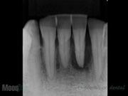 重度歯周病 レントゲン