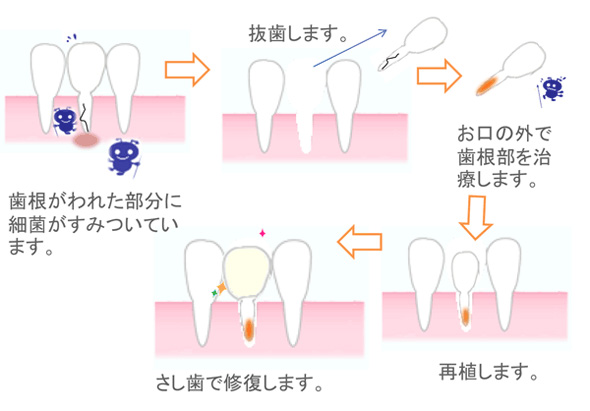 歯の再植療法(自家歯牙移植法)の説明