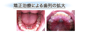 矯正治療による歯列の拡大